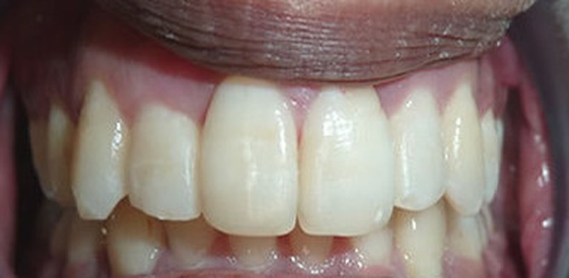 Teeth after Invisalign treatment