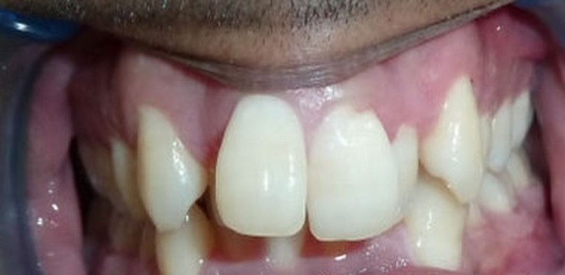 Teeth before Invisalign treatment